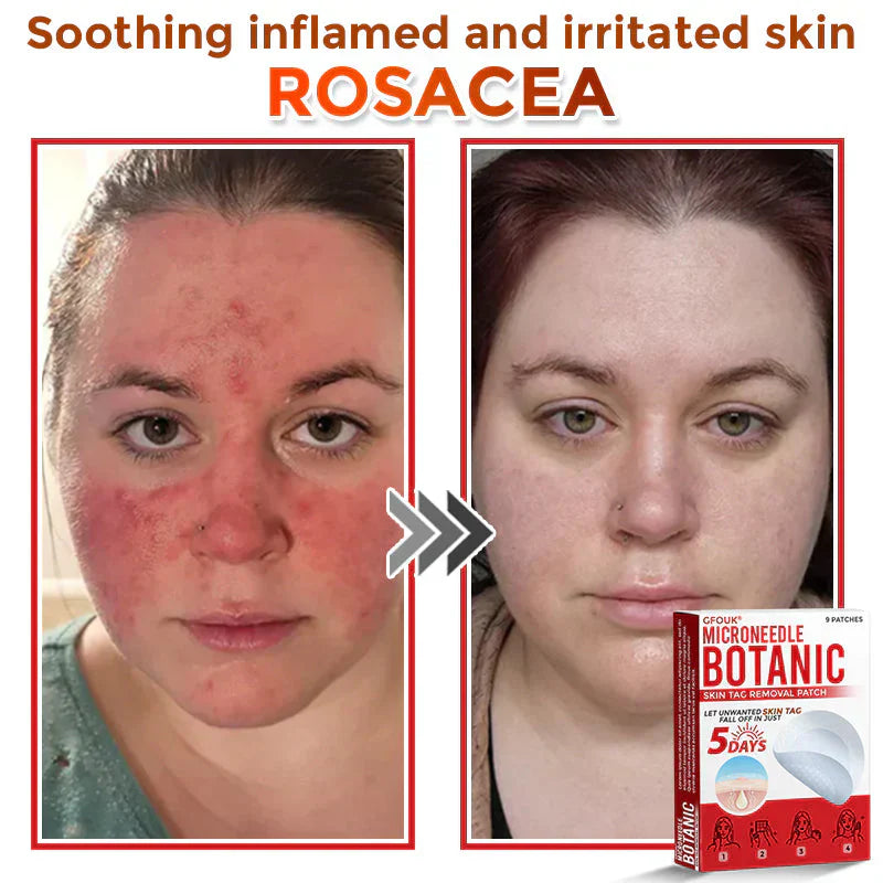 GFOUK® MicroNeedle Botanic Skin Tag Removal Patch